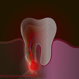 射线效应 从真牙到带有疼痛和炎症点的线性 X 射线效果的过渡 牙根炎症牙根囊性牙髓炎的医学插图图片