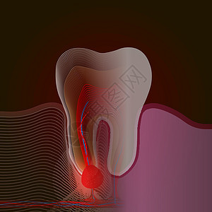 射线效应 从真牙到带有疼痛和炎症点的线性 X 射线效果的过渡 牙根炎症牙根囊性牙髓炎的医学插图背景图片