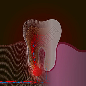 从真正的牙齿过渡到带有疼痛和炎症的点 X 射线效果 牙根炎症 牙根囊肿 牙髓炎的医学插图图片