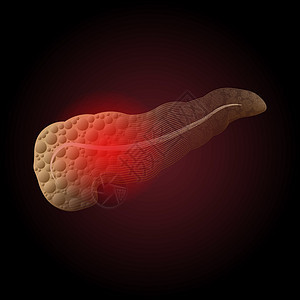 胰腺炎 一个真实器官的胰腺疾病的医学插图 以从具有炎症点的点对 X 射线的影响图片