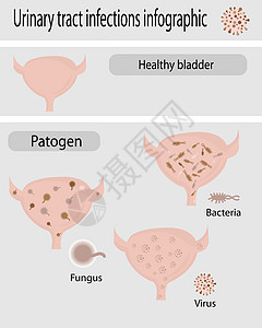 泌尿道感染人口图图片