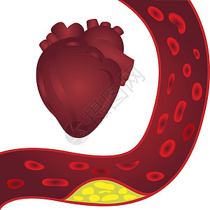 动脉和心脏(甲状腺硬质病)插图图片
