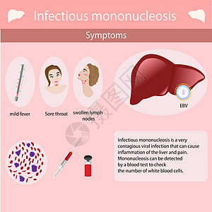 传染性单核细胞增多症的症状药品肝脏科学插图器官艺术卡通片信息医学传染性图片