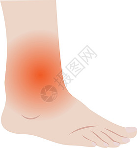 脚和脚踝与感染或受伤的间隔卡通片水疱插图医学压缩医师疼痛破产风险症状图片