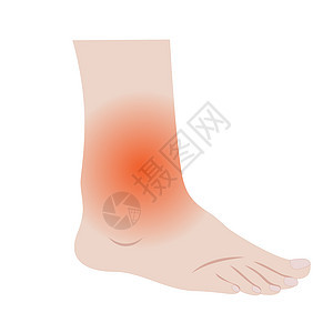 脚和脚踝与感染或受伤的间隔风险医学水疱破产症状身体治疗疾病血管疼痛图片