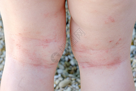 脊髓皮炎腿部划痕的特切性皮肤炎图片