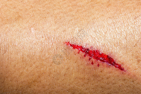 人体皮肤尖锐物体造成的深处伤口图片