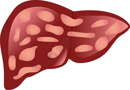 受肝硬化影响的肝脏卡通片障碍器官感染肝炎病人医学身体损害信息图片