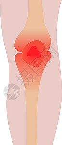 膝膝受伤痛苦药品韧带症状医生风险疼痛疾病医学解剖学图片