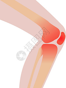 膝关节疼痛 因为它制作图案受伤矢量图片