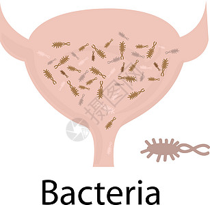 尿路感染 膀胱充满细菌感染图片