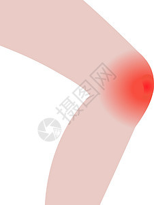 膝盖因感染或受伤而肿胀图片