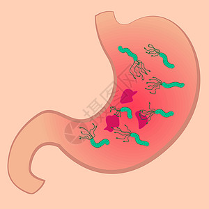 含有溃疡和乙醇苯丙二醇基的胃图片