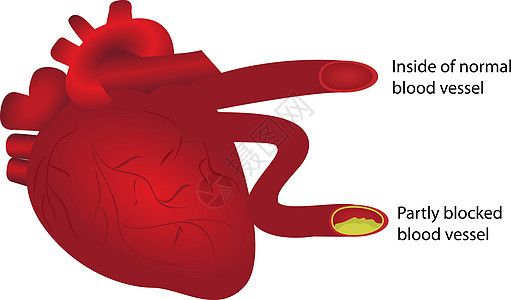 血管正常和部分阻塞的心脏图片