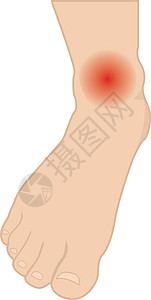 脚和脚踝与感染或受伤的间隔卡通片医学肿胀重量插图破产皮肤医师疾病水疱设计图片