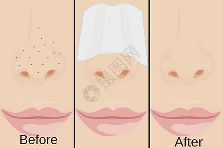 鼻子上的黑头和治疗方法图片