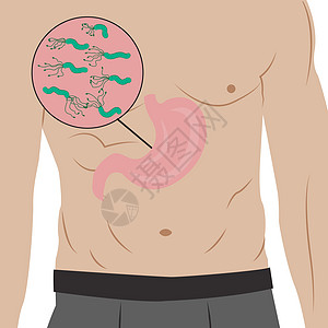 人体内满是幽门螺杆菌的胃 胃炎原因 卡通样式中的矢量插图图片