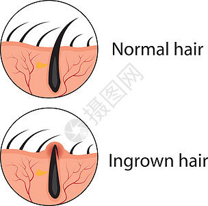 普通和不生长的毛发矢量图图片