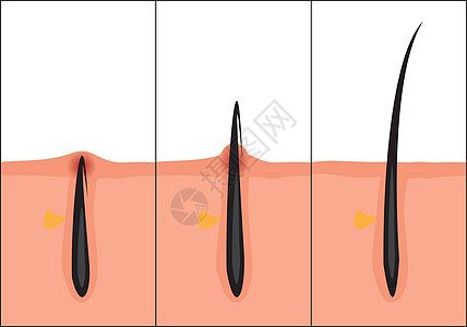 正常和向内生长的头发矢量图 护肤问题图片