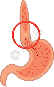 胃食管反流病 肠胃高清图片