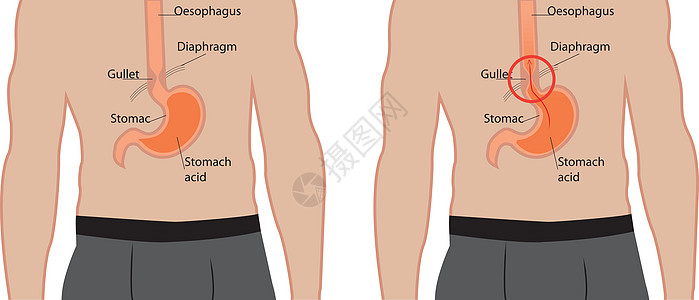 胃食管反流病 人体内的胃食管烧伤症状科学保健插图胃炎身体男人消化图片
