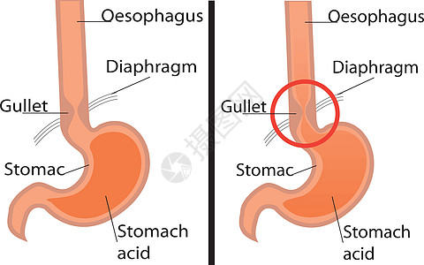 胃食管反流病 健康胃肠图表烧伤器官科学括约肌消化症状疾病保健疼痛图片
