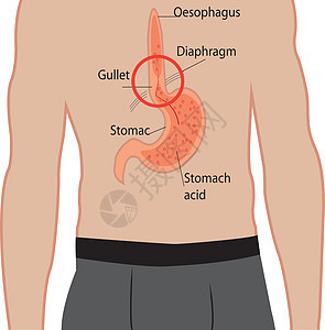 胃食管反流病 人体内的胃插图解剖学科学疼痛症状卫生气体括约肌器官身体图片
