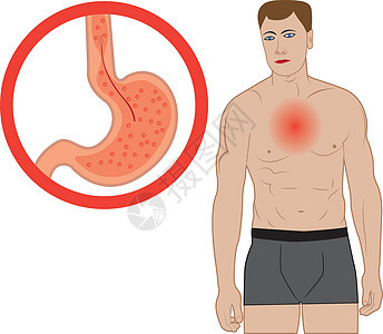 胃食管反流病 人体内的胃疼痛器官食管疾病气体解剖学科学胃炎烧伤括约肌图片