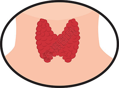 甲状体激素卫生疾病功能器官气管肿胀脖子下丘脑甲亢图片
