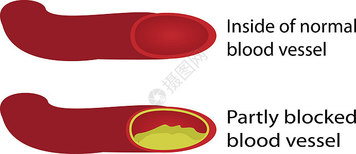 健康和堵塞的血管牌匾静脉管子凝块攻击治疗心脏动脉硬化船只插图背景图片