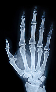 手的X光图像骨骼手臂药品关节腕骨病人扫描创伤科学风湿病图片