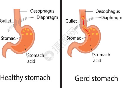 胃食管酸反流病  Gerd 和健康胃载体它制作图案图片