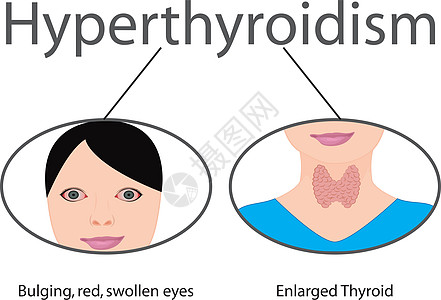 甲亢   甲状腺肿大 内分泌失调图片
