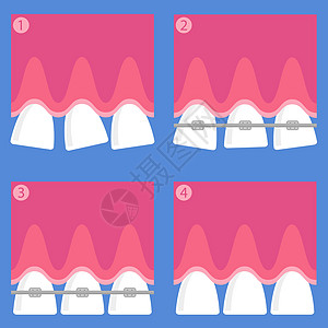 牙齿 牙科护理背景 矫形治疗 卡通开胃口金属医生卫生牙医工具矫正诊所医院微笑支撑图片