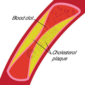 容器中的胆固醇标志图片