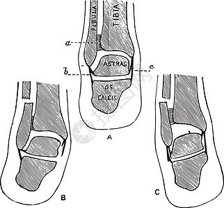 横截面通过下腿 古老的插图图片