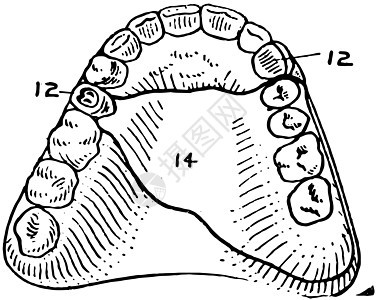 牙科锚固假牙复古插画图片