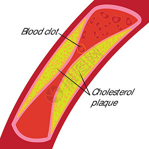 血凝块和胆固醇斑块 血管阻塞图片