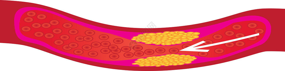 血管中胆固醇斑块的水平心脏心血管动脉心脏病动脉粥样硬化心脏病学控制疾病测试风险图片