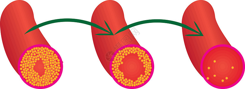降低血管载体它制作图案中的胆固醇斑块水平图片