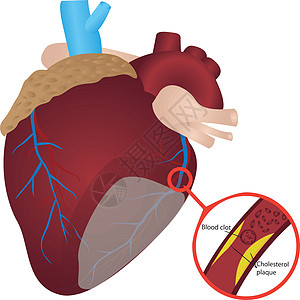 动脉中的血凝固胆固醇斑块攻击人心解剖学静脉心脏心脏病治疗中风急救器官图片