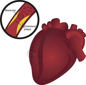 动脉中的血凝固胆固醇斑块心脏病学男人保健静脉心脏心血管牌匾心脏病梗塞治疗图片