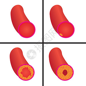 血管中胆固醇斑块的水平控制疾病医生心血管封锁心脏攻击测试验血牌匾图片