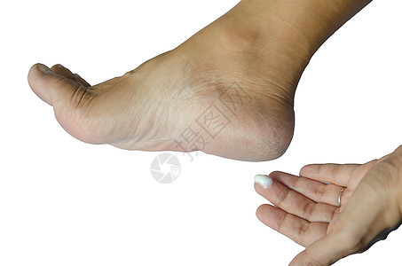 破碎的高跟鞋真菌划痕修脚皮肤身体温泉疾病脚跟卫生治疗图片