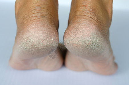破碎的高跟鞋温泉治疗组织身体真菌脚跟划痕皮肤修脚皮炎图片