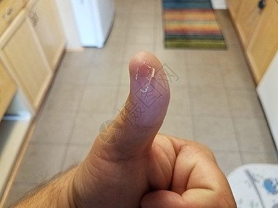厨房内男性手上的拇指剥皮水疱伤害皮肤手指图片