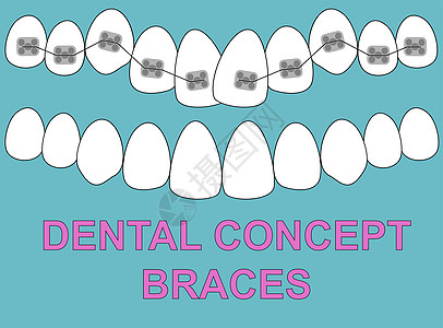 蓝色背景上的横幅上牙套牙齿插图矢量 牙科概念症状牙医纵裂差距矫正健康医生诊所金属治疗图片