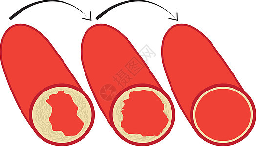 降低血管中胆固醇斑块的水平图片