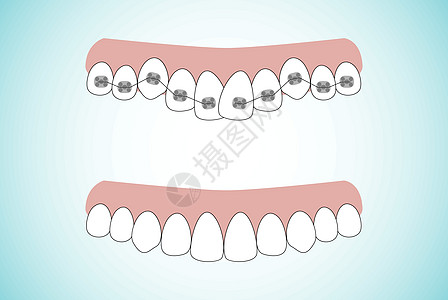牙齿正畸治疗牙套阶段的矢量图解 戴牙套前后的牙齿 平面样式的背景诊所金属微笑海报卫生补给品广告牙医药品牙科插画