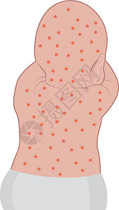 婴儿背部受湿疹滑雪影响图片